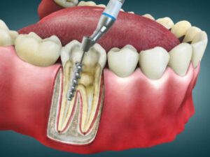 Root Canal Treatment