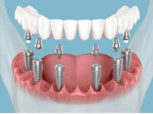 Dental Implants