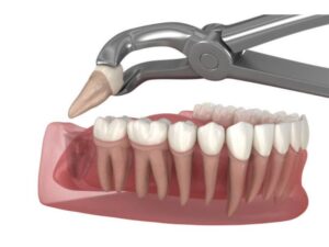 Wisdom Teeth Removal